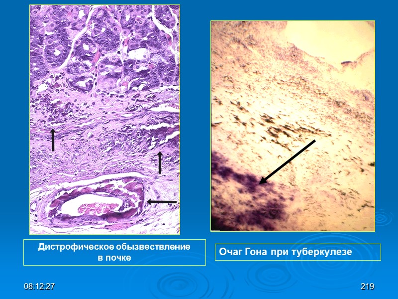 08:12:02 Дистрофическое обызвествление в почке Очаг Гона при туберкулезе 219